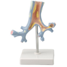 Pathological Model of the Bronchi