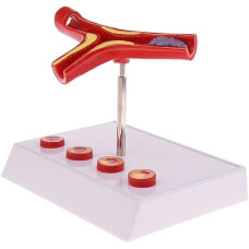 Atherosclerosis and Thrombosis Model