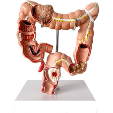 Disease Large Intestines (Details), 1/2X life size