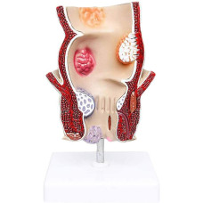 Pathological Model of the Rectum